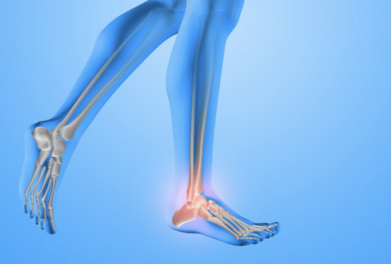 Spolon Radiography Espolón Calcáneo: causas, síntomas y tratamiento – Sportsalud Clínica ...